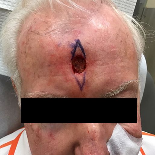 Mohs Surgery - Case 3 before
