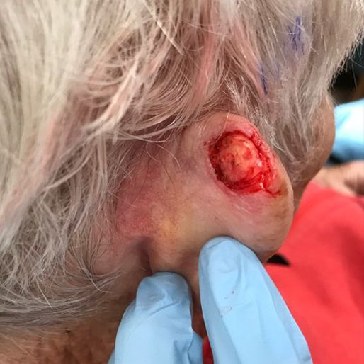 Mohs Surgery - Case 30 before