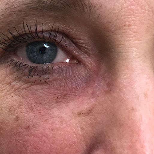 Mohs Surgery - Case 31 After