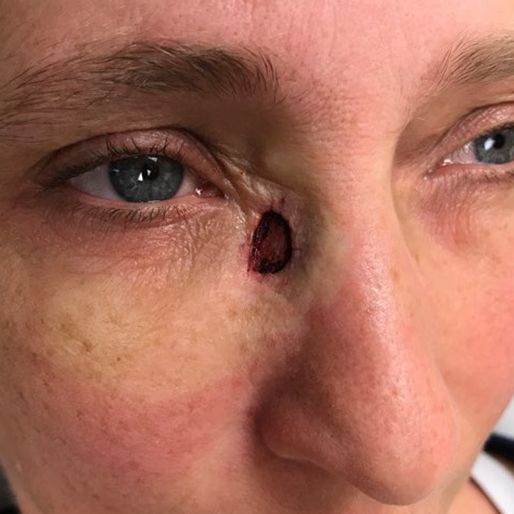 Mohs Surgery - Case 31 before