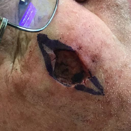 Mohs Surgery - Case 32 before