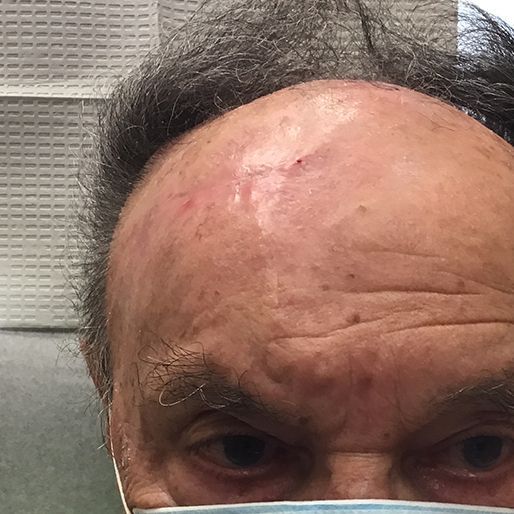 Mohs Surgery - Case 33 After