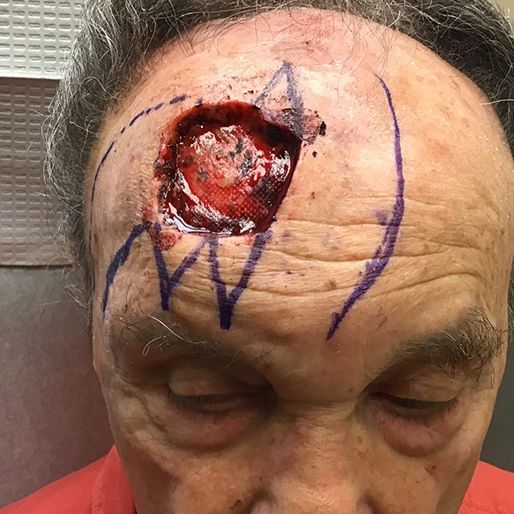 Mohs Surgery - Case 33 before