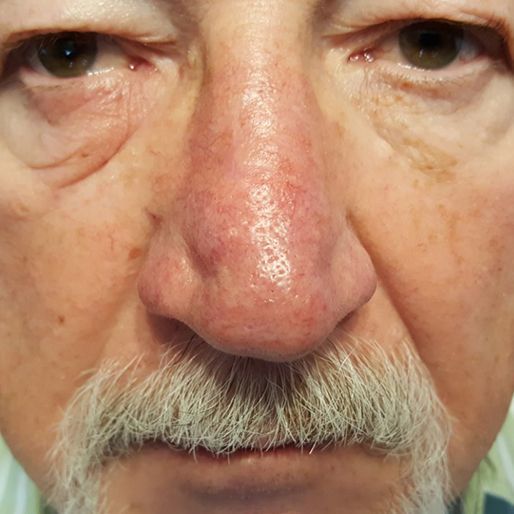 Mohs Surgery - Case 34 After
