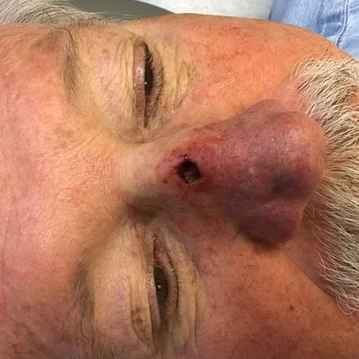 Mohs Surgery - Case 34 before