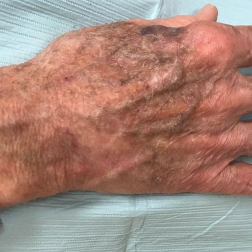 Mohs Surgery - Case 35 After