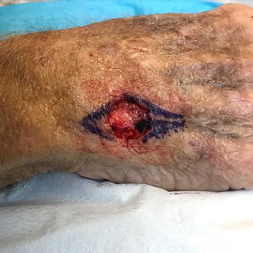 Mohs Surgery - Case 35 before