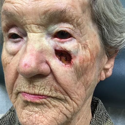 Mohs Surgery - Case 36 before