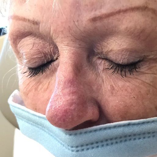 Mohs Surgery - Case 37 After