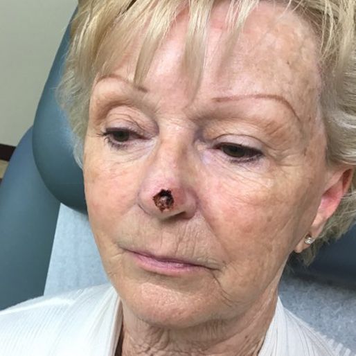 Mohs Surgery - Case 37 before