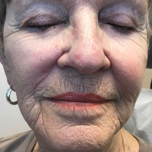 Mohs Surgery - Case 38 After