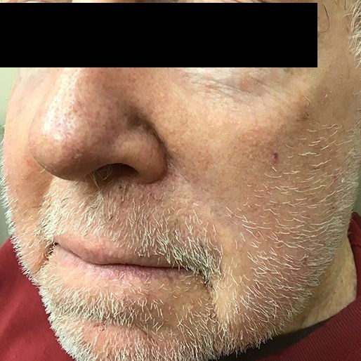 Mohs Surgery - Case 4 After