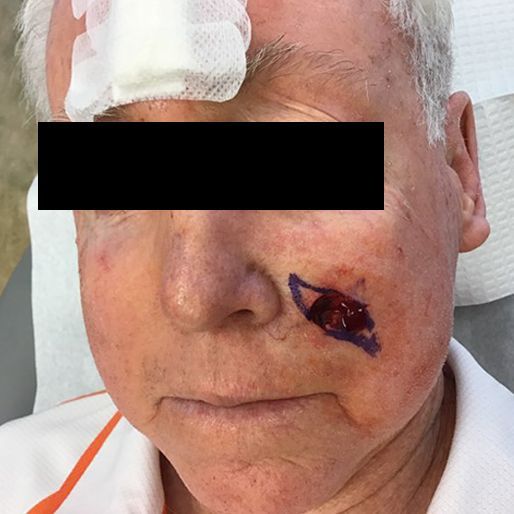 Mohs Surgery - Case 4 before