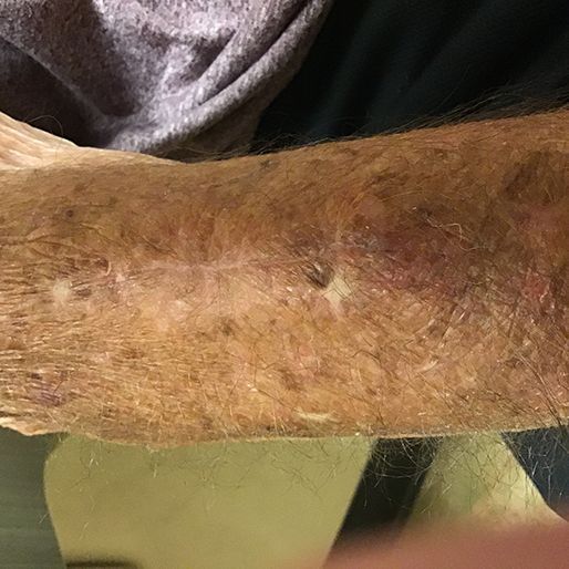 Mohs Surgery - Case 5 After