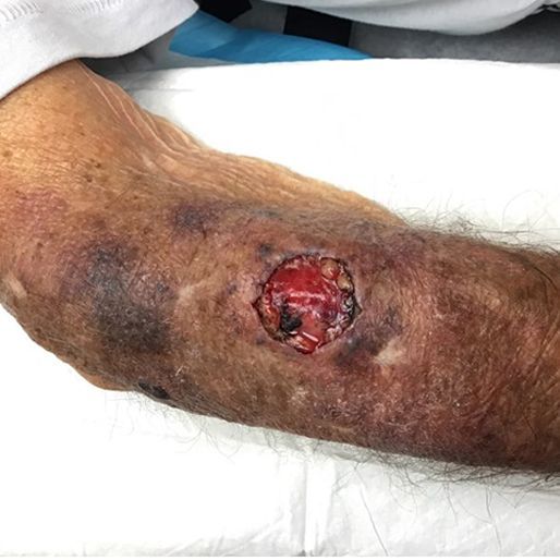 Mohs Surgery - Case 5 before