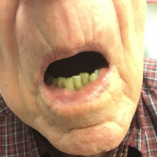 Mohs Surgery - Case 6 After