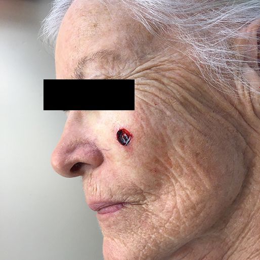 Mohs Surgery - Case 7 before