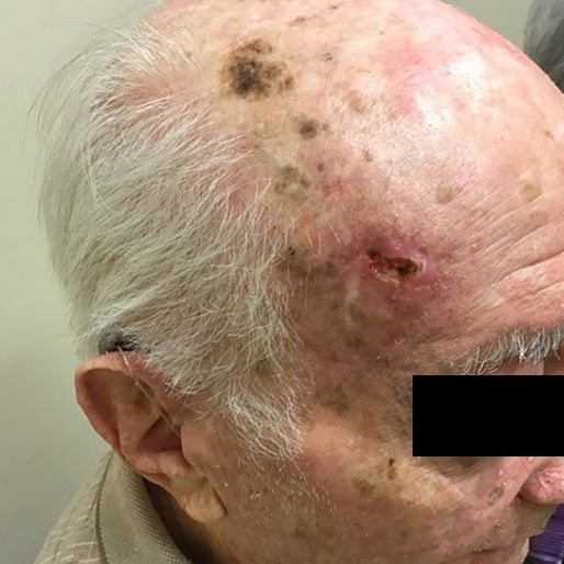Mohs Surgery - Case 8 After