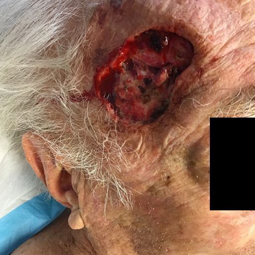 Mohs Surgery - Case 8 before