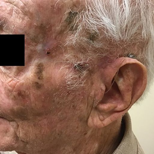 Mohs Surgery - Case 9 After