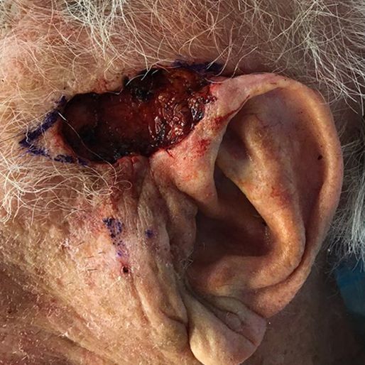 Mohs Surgery - Case 9 before