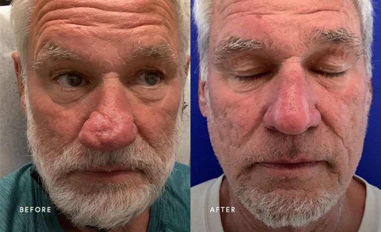 phoenix surgical dermatology group - real patient before and after treatment for rhinophyma skin condition on the nose