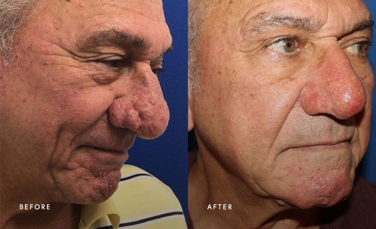 phoenix surgical dermatology group - real patient before and after treatment for rhinophyma skin condition on the nose