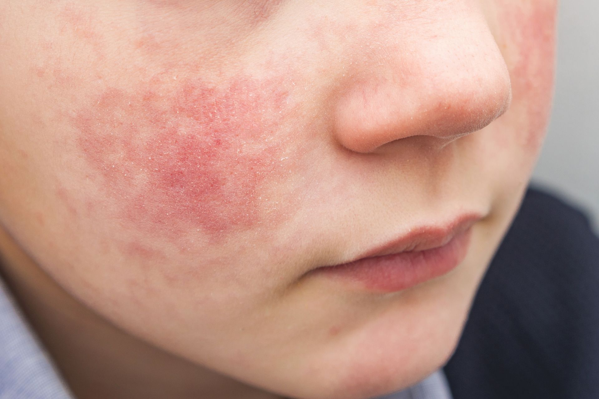 child+experiencing+eczema+breakout+in+phoenix