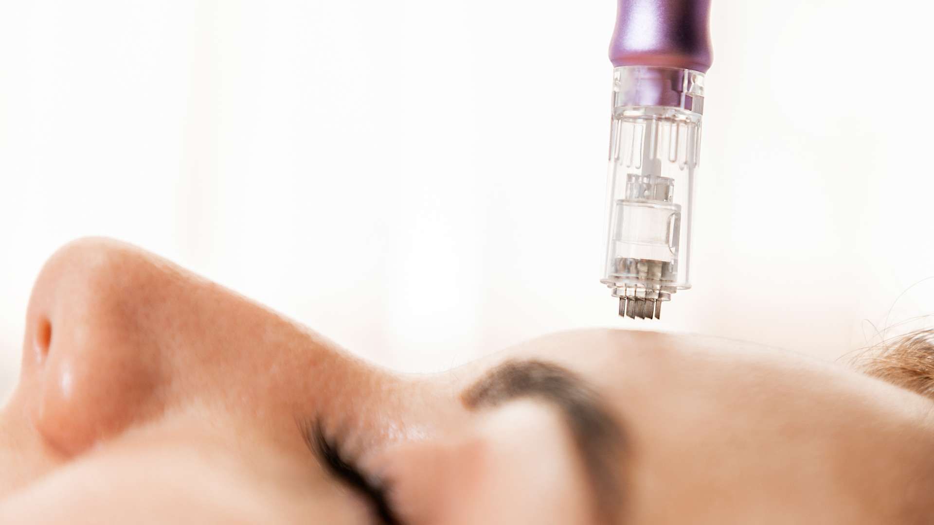 Close-up of a facial microneedling treatment with a device held above the skin
