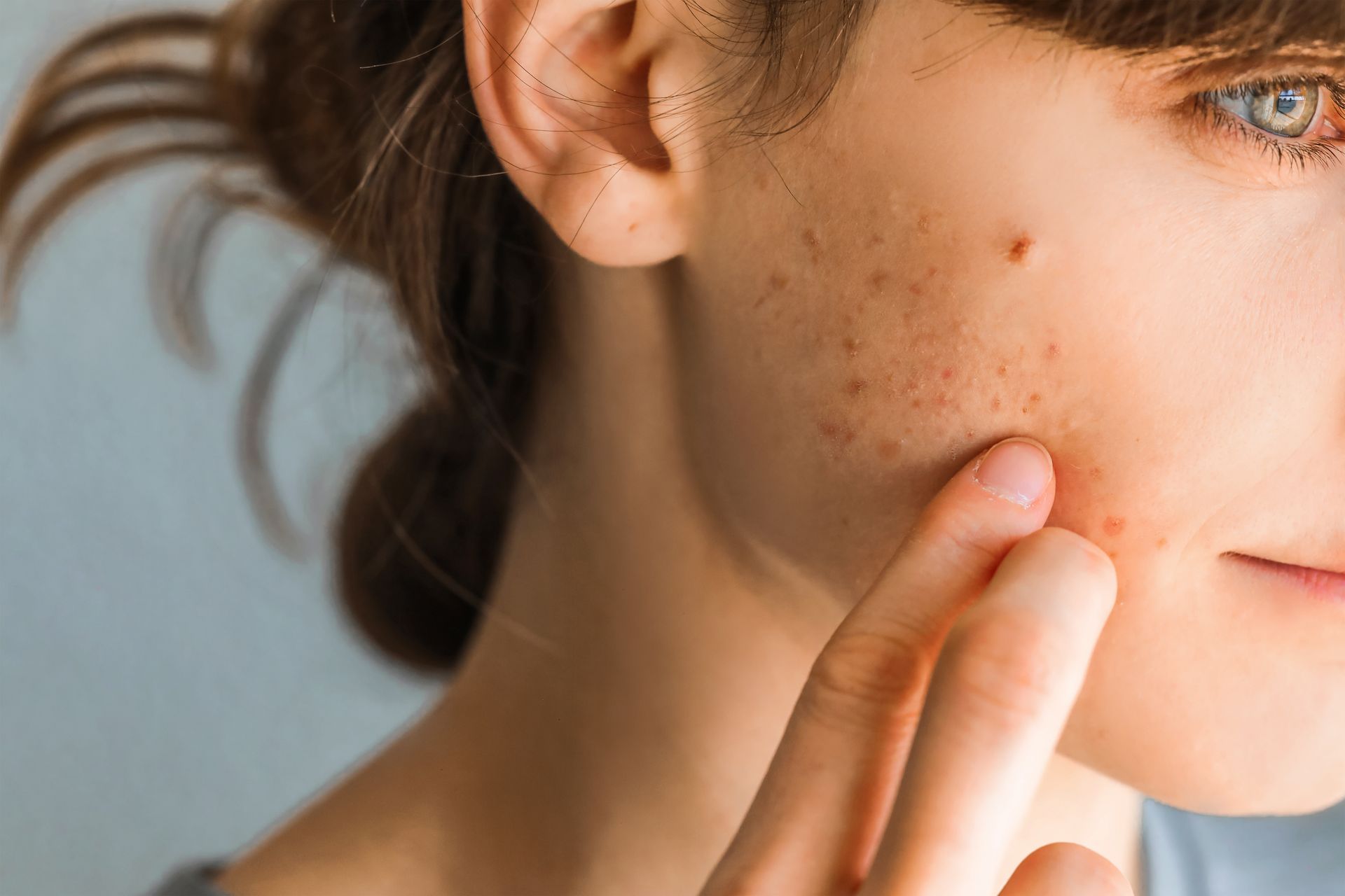 woman with acne on chin, close up image