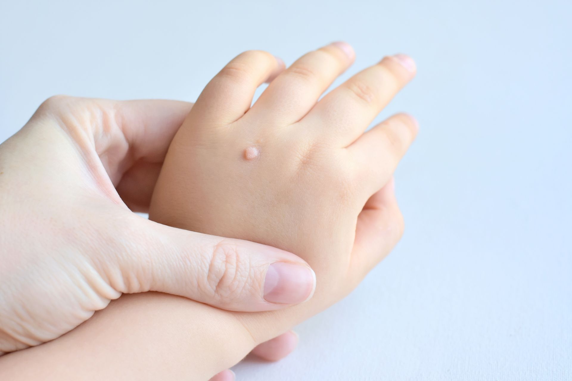 pediatric+patient+prepping+for+wart+removal+in+phoenix+arizona