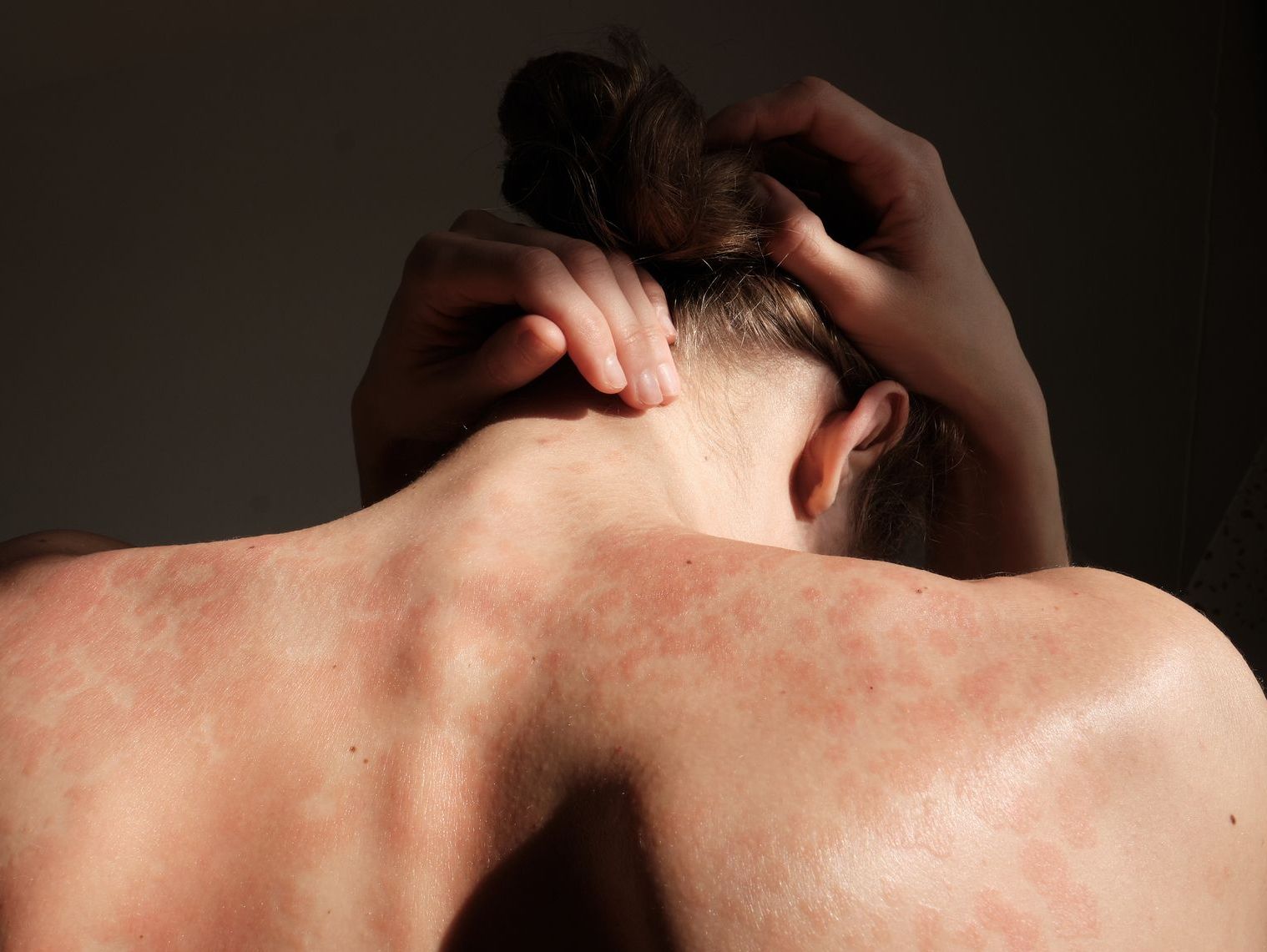 person-in-phoenix-arizona-with-psoriasis-ready-to-go-see-a-dermatologist
