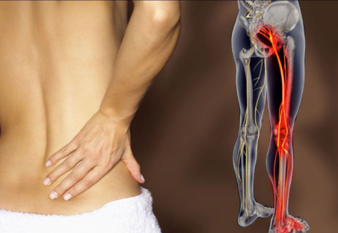 dolore alla sciatica
