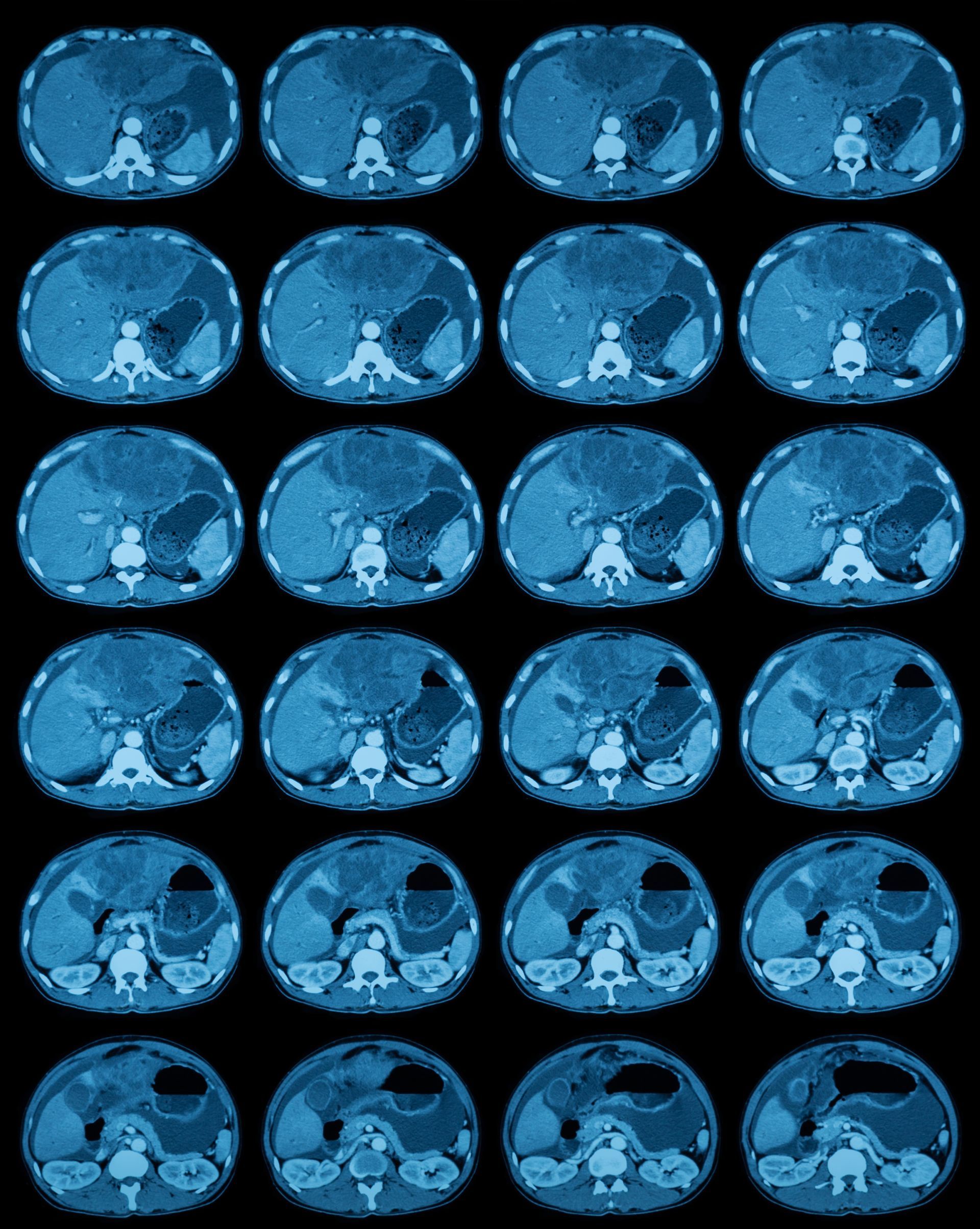 CT scan of abdomen, series of cross-sectional views. Internal organs show in shades of blue.