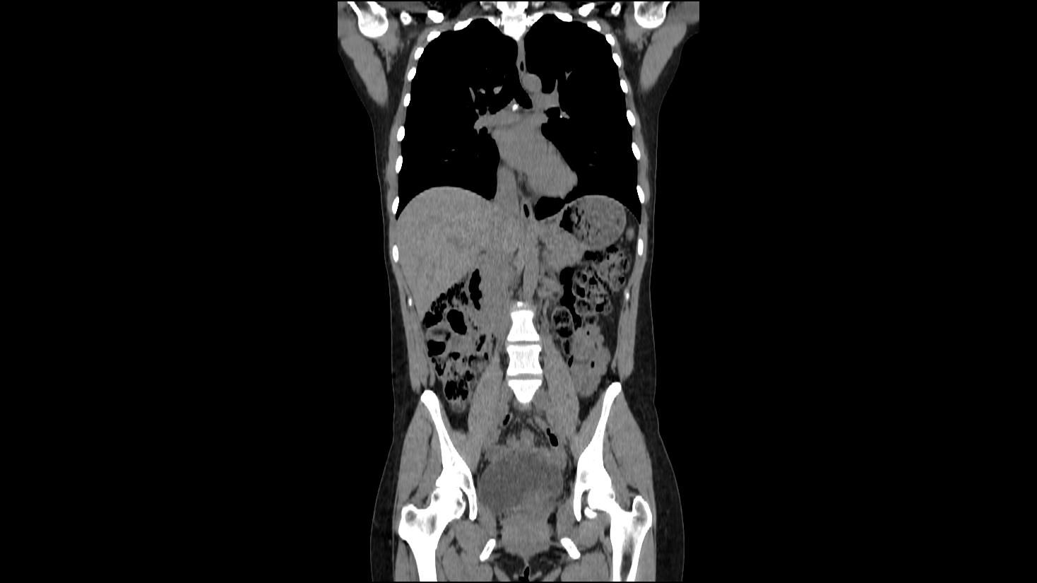 Coronal CT scan of human torso, showing internal organs: lungs, liver, intestines, and pelvic bones. Coronal CT scan of human torso, showing internal organs: lungs, liver, intestines, and pelvic bones.