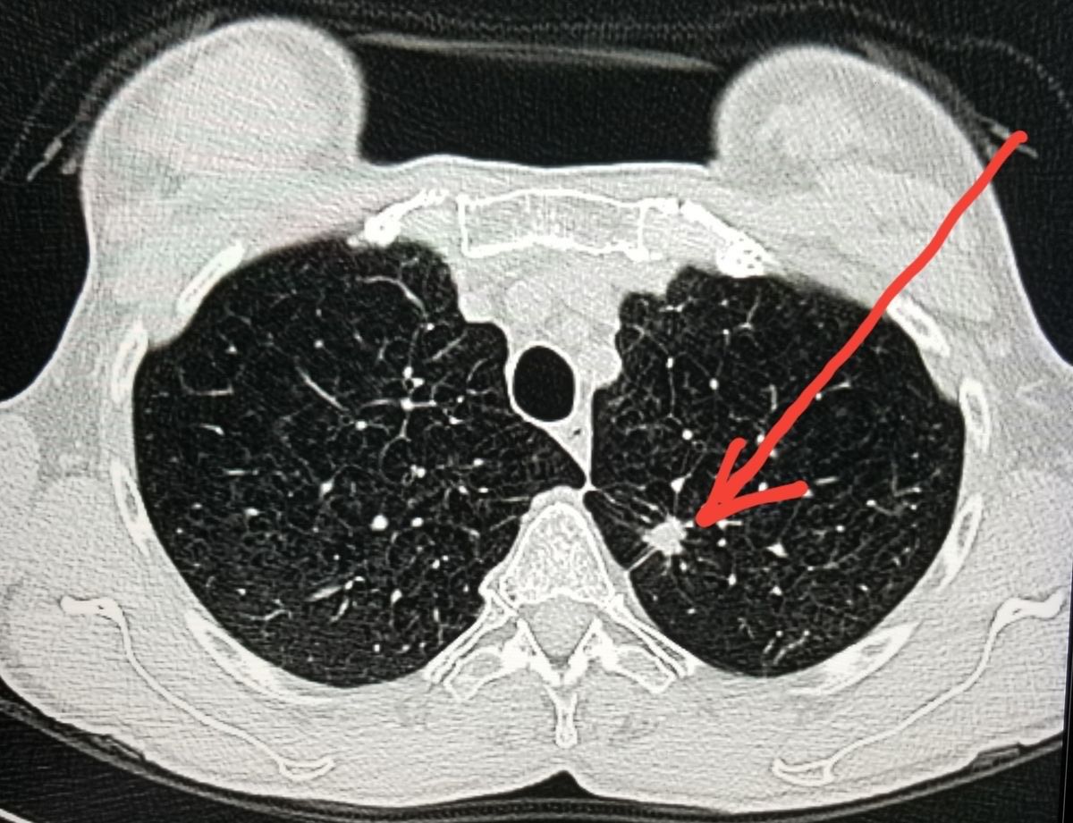 CT scan, lung scan, lung nodule CT scan result of lungs showing nodule.