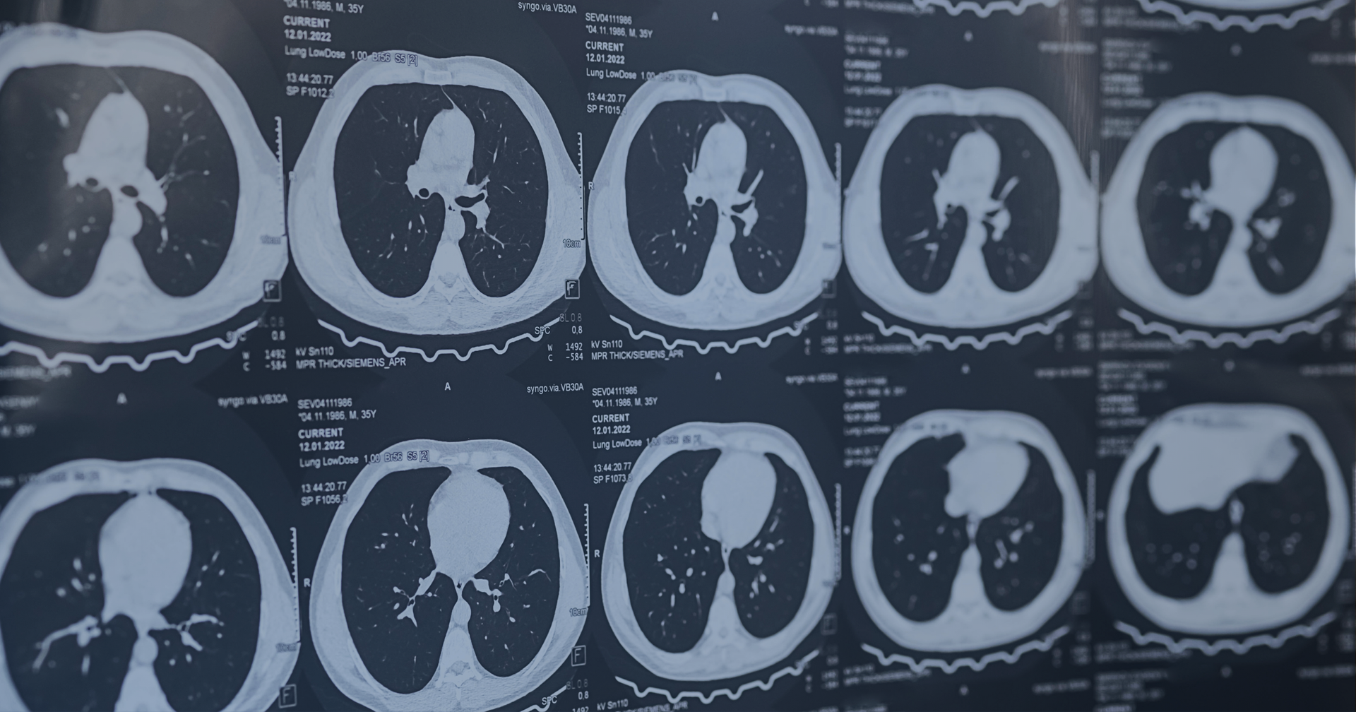 CT scan, lung scan, lung nodules CT scan results for lungs