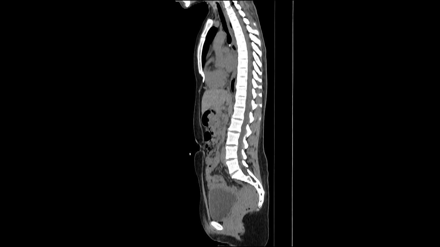 Sagittal CT scan of a human torso, showing spine, internal organs, and potential abnormalities. Sagittal CT scan of a human torso, showing spine, internal organs, and potential abnormalities.