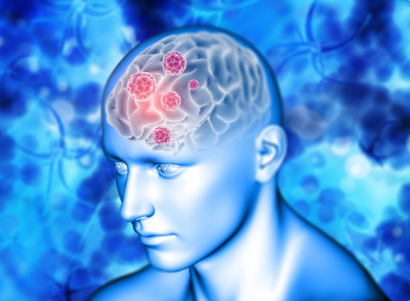 Cirurgia minimamente invasiva para aneurisma cerebral no Rio de Janeiro