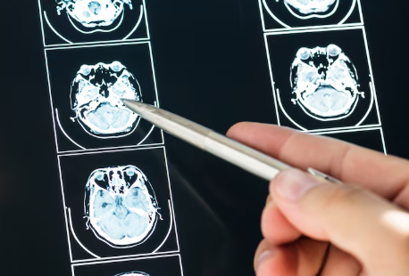 Quanto tempo leva a recuperação de uma microcirurgia cerebral no RJ Quanto tempo leva a recuperação de uma microcirurgia cerebral no RJ