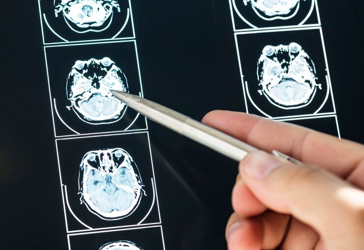 Tumor cerebral causa crises convulsivas?