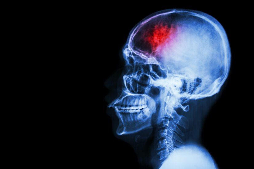 Cirurgia para fraturas cranianas: quando é necessária