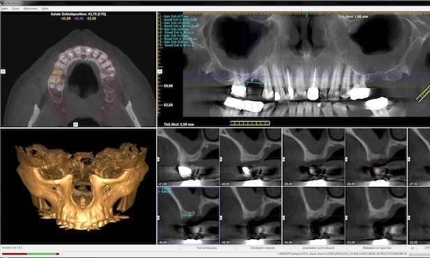 DVT digitale Volumentomographie 3D-Röntgen