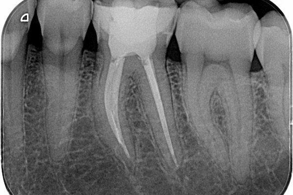 Wurzelbehandlung beim Zahnarzt
