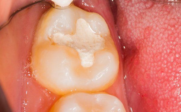 Karies-Therapie - Zahnarzt Springe-Bennigsen Dr. Riegelmann
