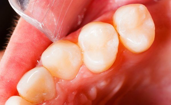 Wann sollte eine Zahnfüllung aus Amalgam ausgetauscht werden?