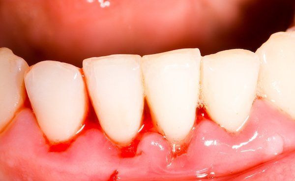 Zahnfleischbluten wegen Parodontose / Parodontitis
