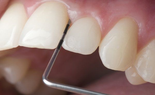 gesundes Zahnfleisch statt Parodontose