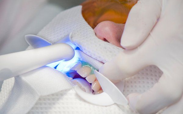 Power-Bleaching beim Zahnarzt für weiße Zähne
