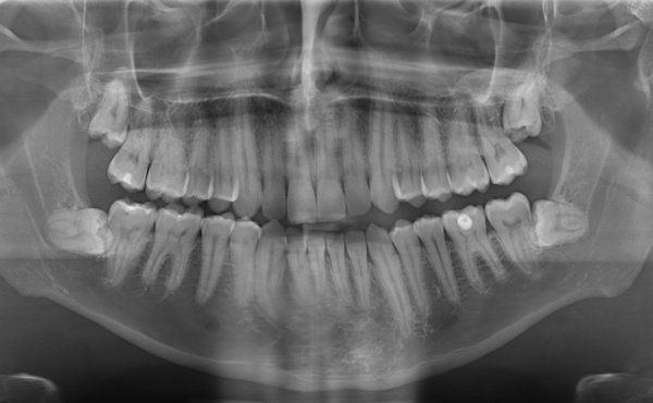 digitales Röntgenbild der Zähne